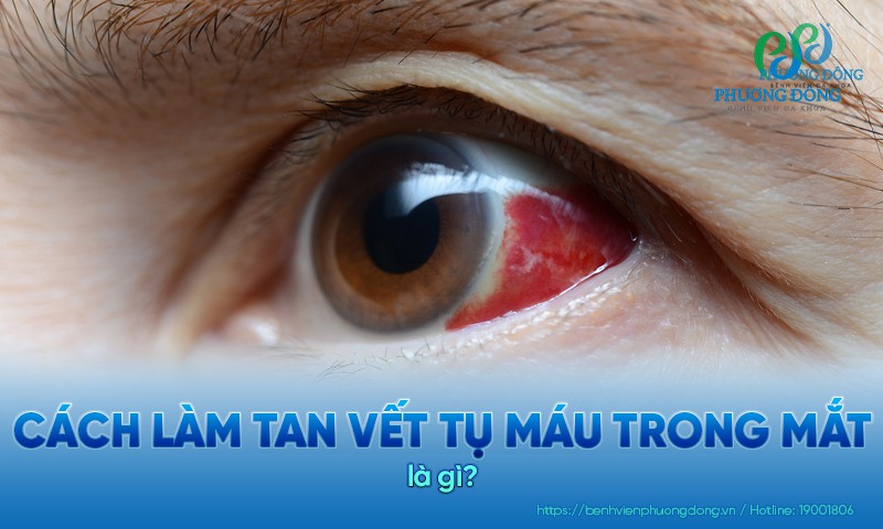 Cách làm tan vết tụ máu trong mắt an toàn và hiệu quả