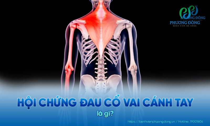 Hội chứng đau cổ vai cánh tay: Nguyên nhân, triệu chứng và điều trị
