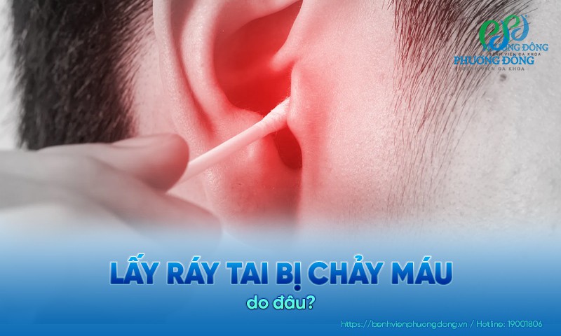 Lấy ráy tai bị chảy máu: Nguyên nhân, điều trị và phòng ngừa