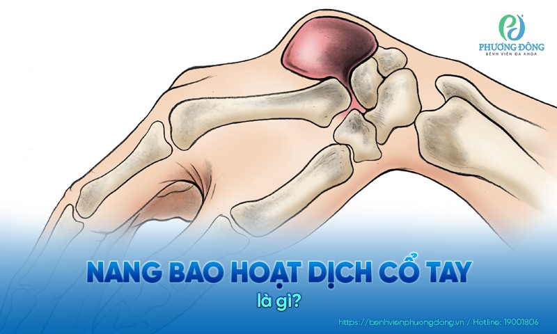 Nang bao hoạt dịch cổ tay: Nguyên nhân, triệu chứng và điều trị