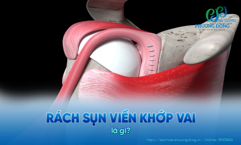 Rách sụn viền khớp vai: Triệu chứng, nguyên nhân và điều trị