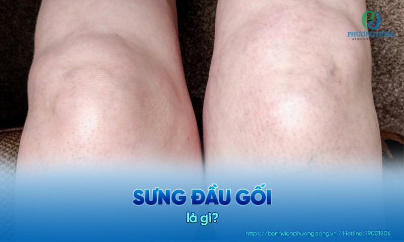 Sưng đầu gối: Nguyên nhân, triệu chứng và phương pháp điều trị