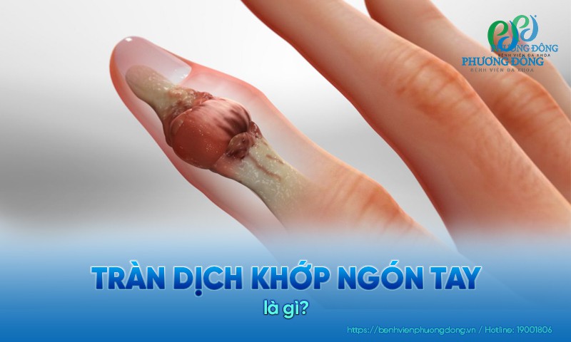 Tràn dịch khớp ngón tay: Nguyên nhân, triệu chứng và điều trị