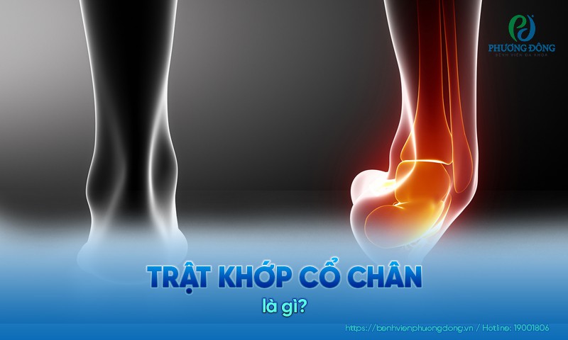 Trật khớp cổ chân: Triệu chứng, nguyên nhân và điều trị