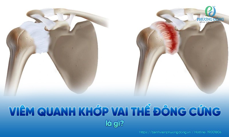 Viêm quanh khớp vai thể đông cứng do đâu? Dấu hiệu nhận biết