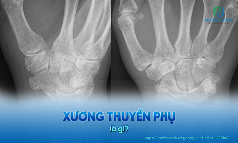 Xương thuyền phụ: Nguyên nhân, triệu chứng và hướng điều trị