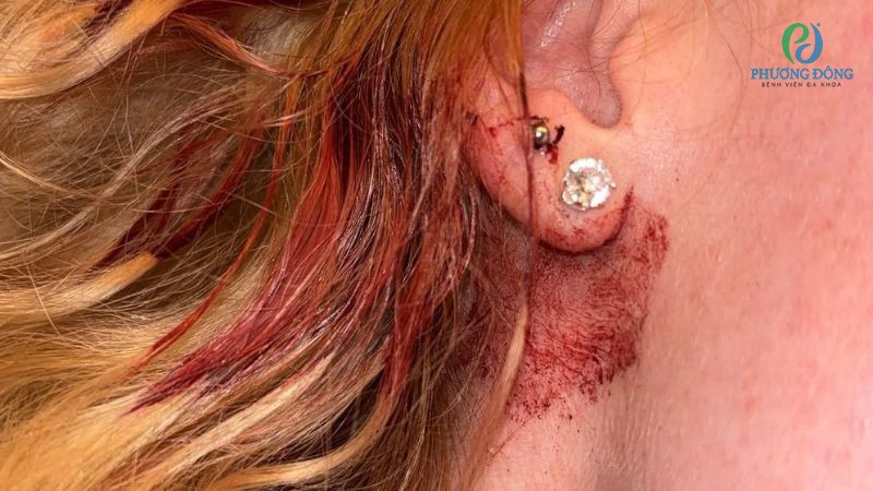 Nguyên nhân gây sưng, chảy máu tai sau khi bấm khuyên