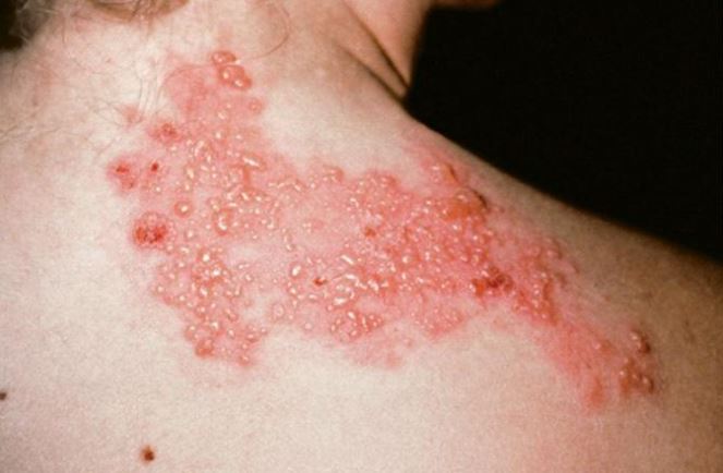 Bệnh zona và những điều cần biết