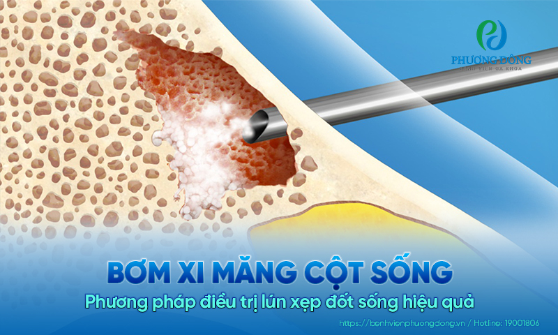 Bơm xi măng cột sống: Phương pháp điều trị lún xẹp đốt sống hiệu quả