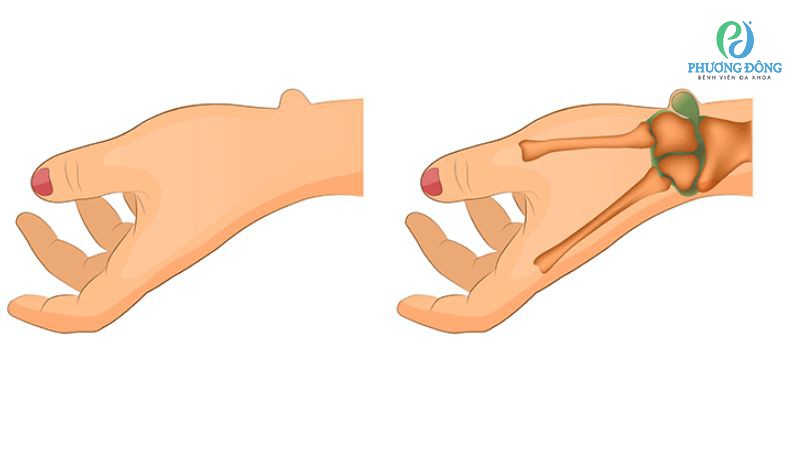 Biểu hiện lâm sàng của u nang hoạt dịch