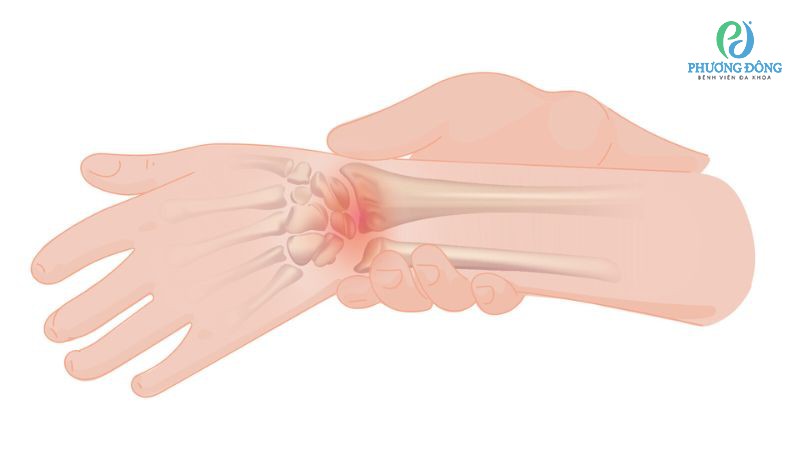 Nguyên nhân liên quan hình thành nên bướu hoạt dịch