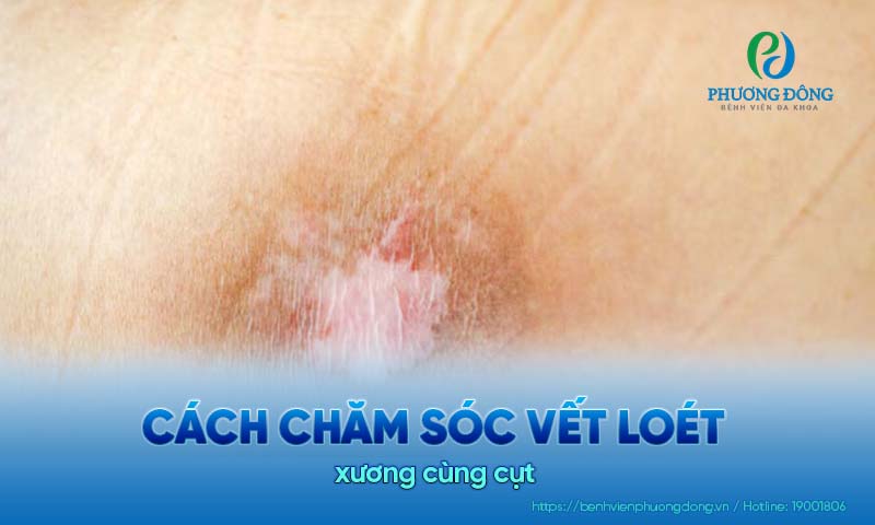 Các vết loét có thể xuất hiện sau thời gian dài chăm sóc nằm một chỗ sau gãy xương