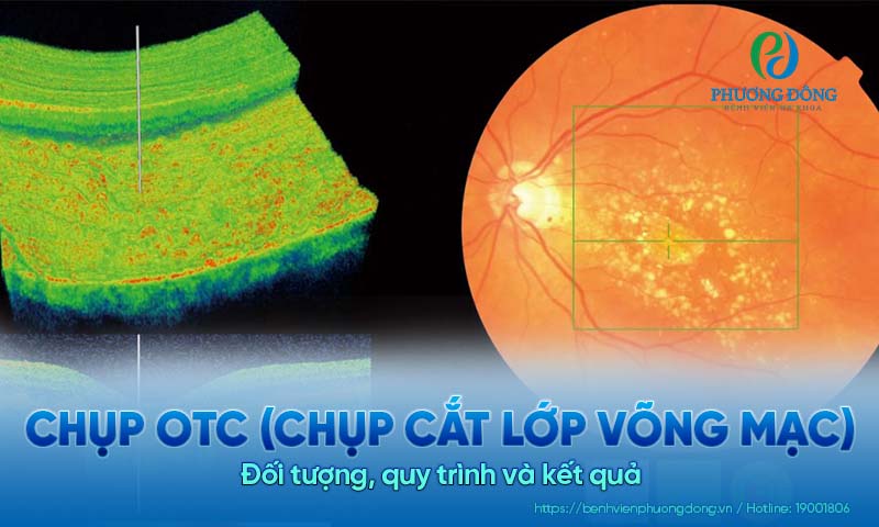 Chụp OTC (chụp cắt lớp võng mạc): Đối tượng, quy trình và kết quả