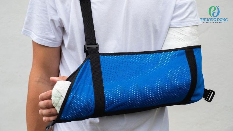 Bất động kéo dài là nguyên nhân khiến cứng khớp ngón tay sau bó bột