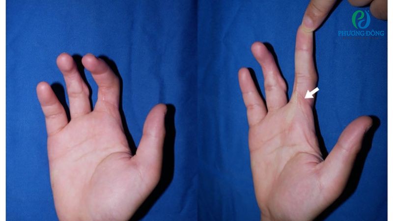 Mô sẹo phát triển quá mức làm cản trở chuyển động của khớp ngón tay