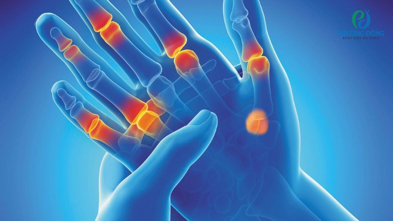 Dấu hiệu nhận biết chức năng khớp ngón tay bị ảnh hưởng sau bó bột