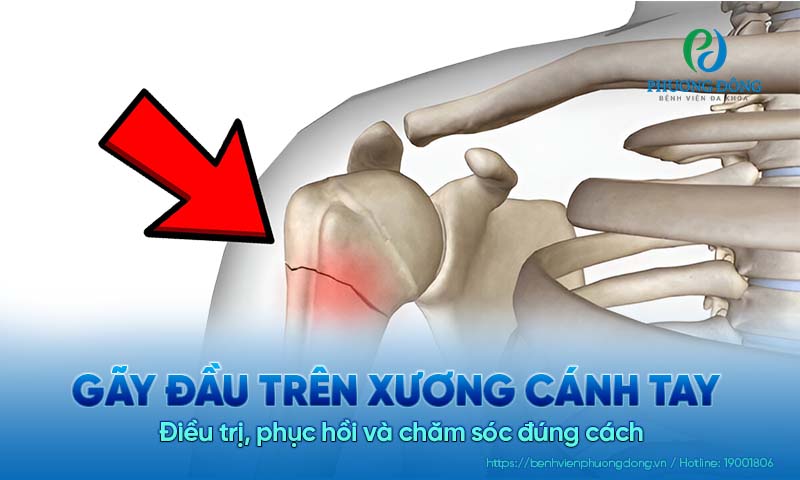 Gãy đầu trên xương cánh tay: Điều trị, phục hồi và chăm sóc đúng cách