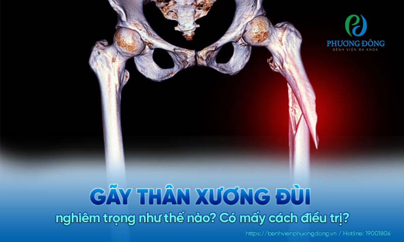 Gãy xương thân đùi nghiêm trọng như thế nào? Có mấy cách điều trị?