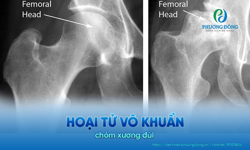 Người bệnh có thể bị hoại tử chỏm xương đùi dần dần