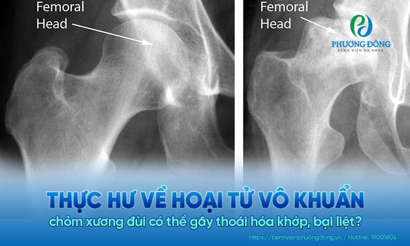 Thực hư về hoại tử vô khuẩn chỏm xương đùi có thể gây thoái hóa khớp, bại liệt?