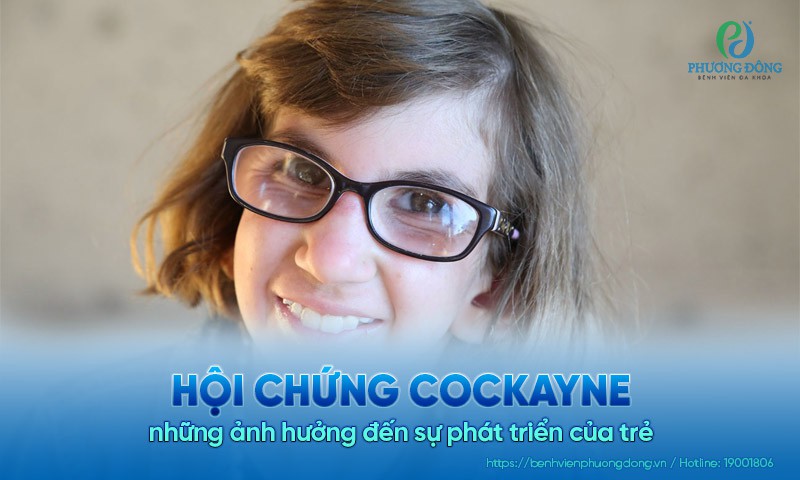 Hội chứng Cockayne và những ảnh hưởng đến sự phát triển của trẻ