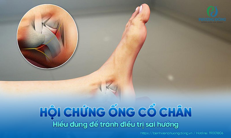 Hội chứng ống cổ chân: Hiểu đúng để tránh điều trị sai hướng
