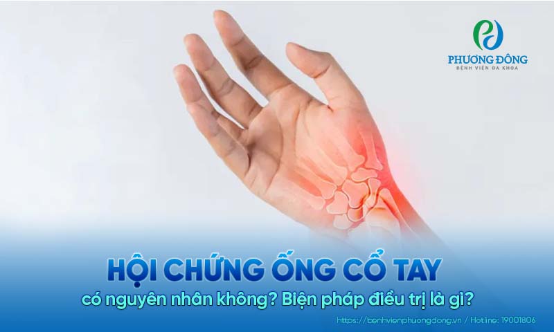 Hội chứng ống cổ tay có nguyên nhân không? Biện pháp điều trị là gì?