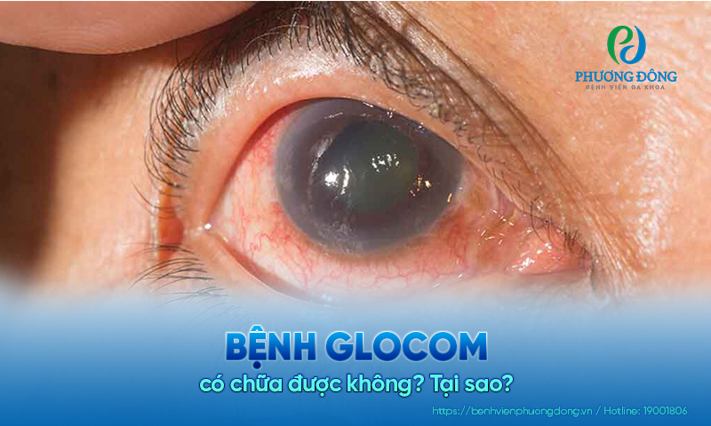 Bệnh glocom có chữa được không? Tại sao?