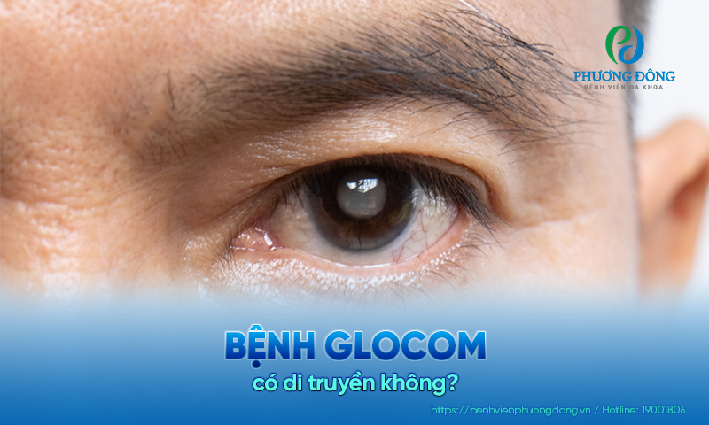 Hỏi đáp: Bệnh glocom có di truyền không?