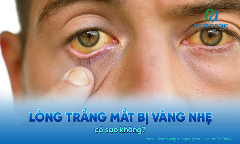 Giải đáp các bệnh lý về mắt: Lòng trắng mắt bị vàng nhẹ có sao không?