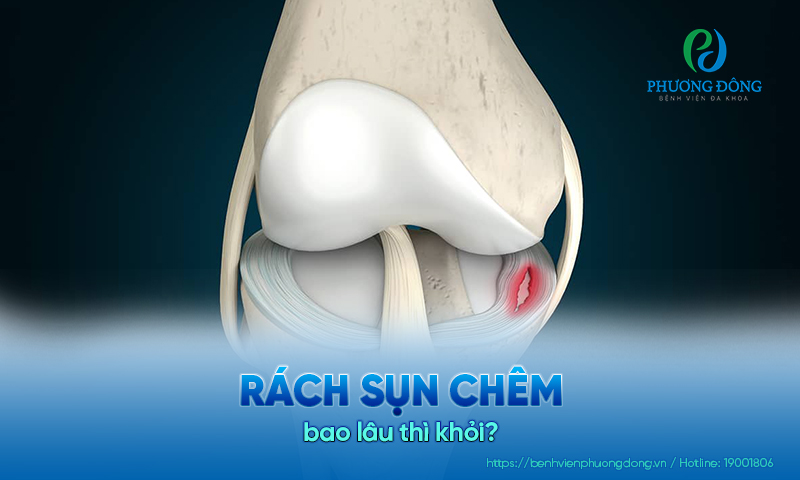 Bác sĩ chuyên khoa giải đáp: Rách sụn chêm bao lâu thì khỏi?