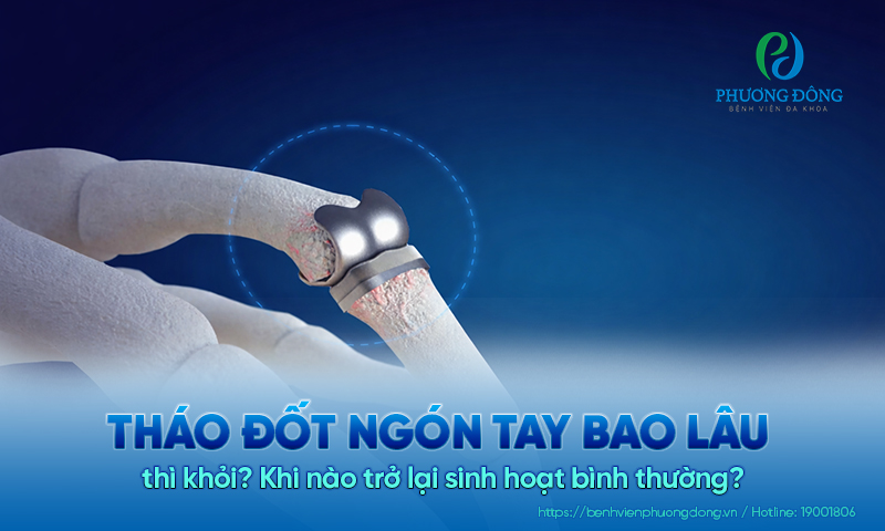 Tháo đốt ngón tay bao lâu thì khỏi? Khi nào trở lại sinh hoạt bình thường?