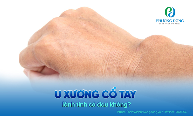 Giải đáp bệnh lý cơ xương khớp: U xương cổ tay lành tính có đau không?