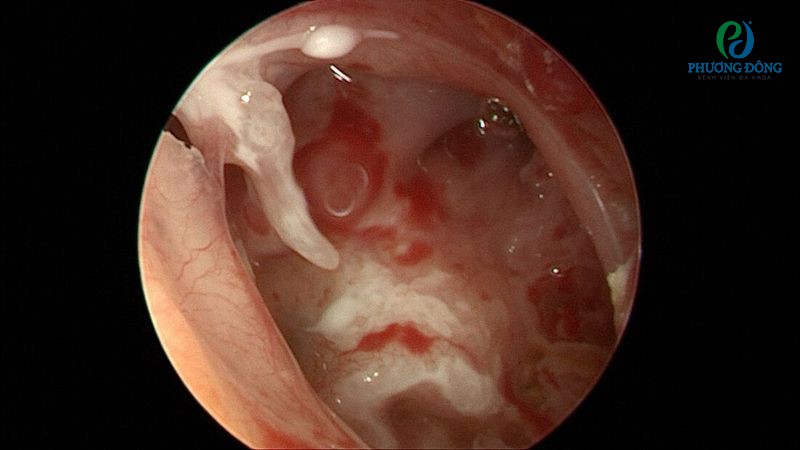 Lấy ráy tai bị chảy máu do màng nhĩ bị thủng trong quá trình thực hiện