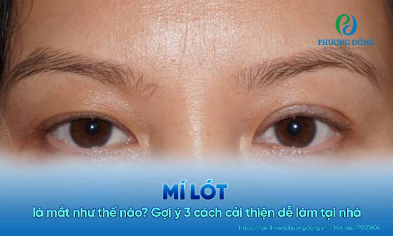 Mí lót là mắt như thế nào? Gợi ý 3 cách cải thiện dễ làm tại nhà