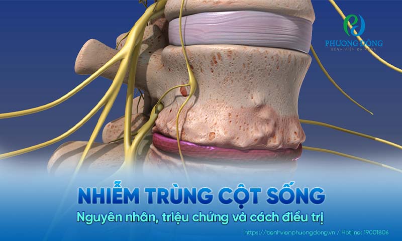 Nhiễm trùng cột sống: Nguyên nhân, triệu chứng và cách điều trị 