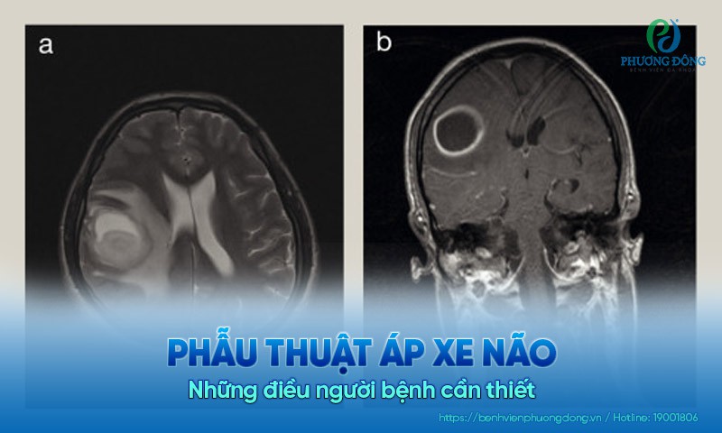 Phẫu thuật áp xe não: Những điều người bệnh cần thiết