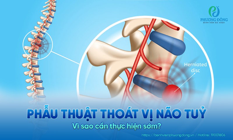 Phẫu thuật thoát vị não tuỷ: Vì sao cần thực hiện sớm?