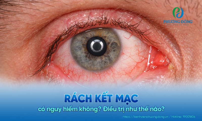Rách kết mạc có nguy hiểm không? Điều trị như thế nào?