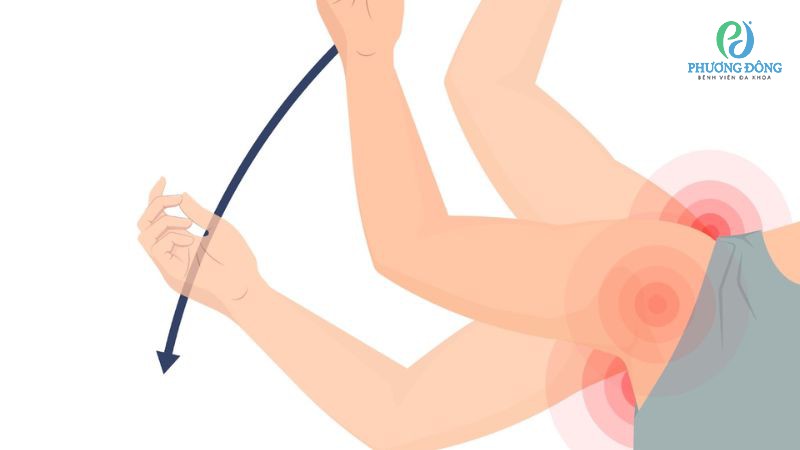 Dấu hiệu nghi ngờ khớp vai bị nứt rách sụn viền
