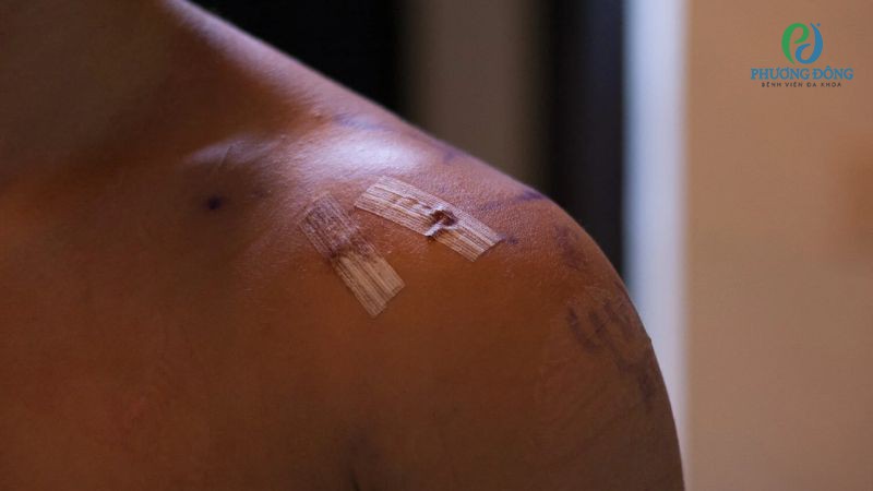 Điều trị ngoại khoa nứt sụn viền khớp vai với trường hợp tổn thương nghiêm trọng