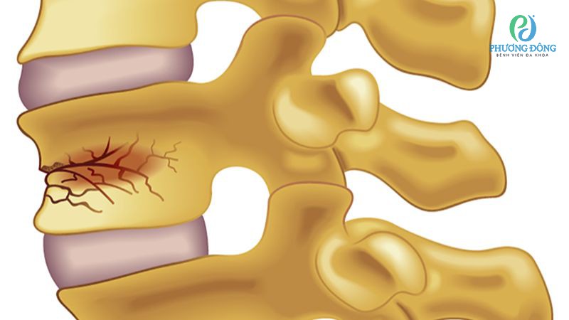 Cột sống thắt lưng là vị trí dễ bị chấn thương dẫn đến rạn nứt