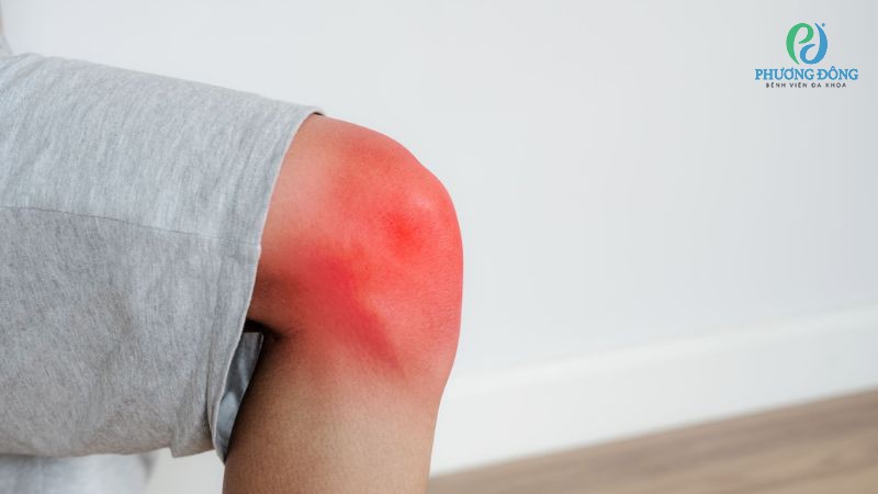 Biểu hiện lâm sàng kèm theo tình trạng đầu gối sưng nề