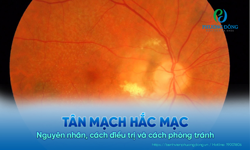 Tân mạch hắc mạc: Nguyên nhân, cách điều trị và cách phòng tránh 