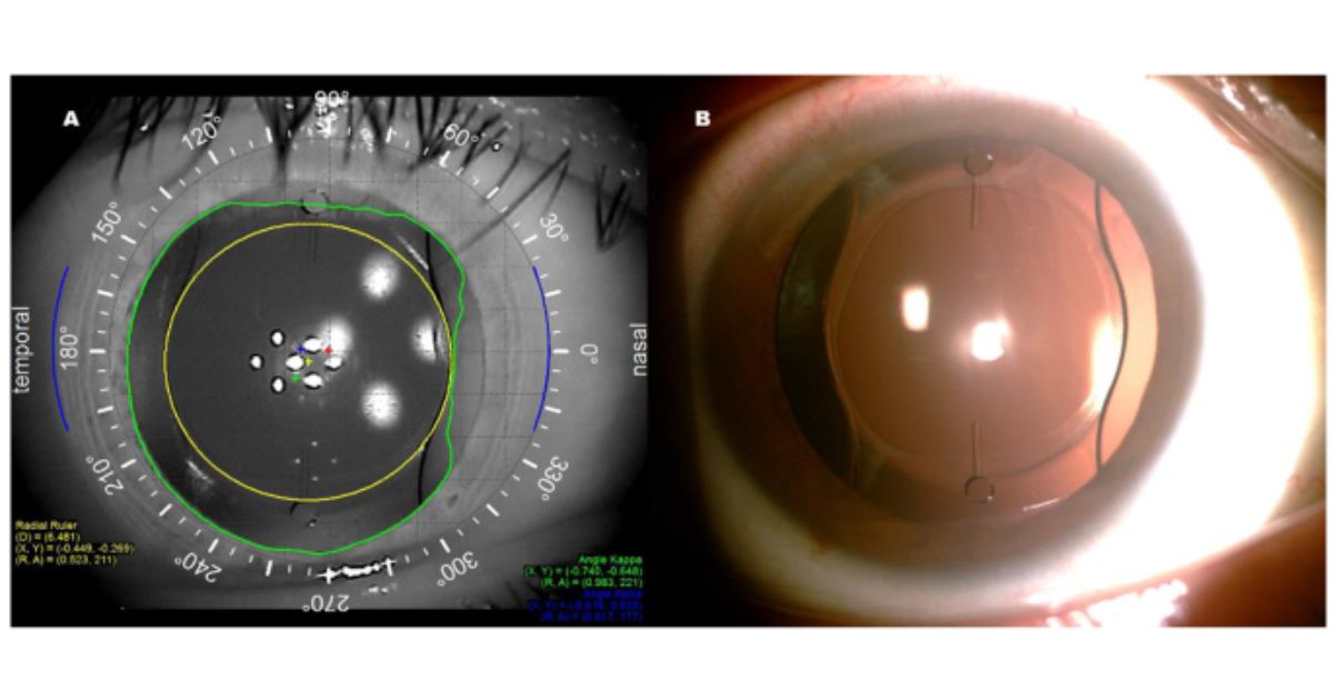 Riêng với phẫu thuật Phakic, thấu kính mới được cấy vào mắt nhưng thấu kính tự nhiên không bị loại bỏ