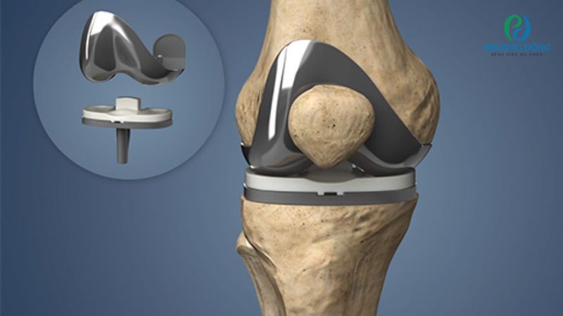 Thời gian phục hồi ảnh hưởng bởi phương pháp phẫu thuật thay khớp gối