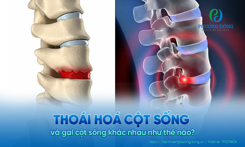 Thoái hoá cột sống và gai cột sống khác nhau như thế nào? 