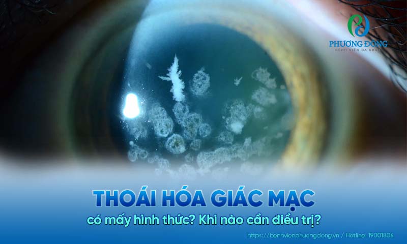 Thoái hóa giác mạc có mấy hình thức? Khi nào cần điều trị?