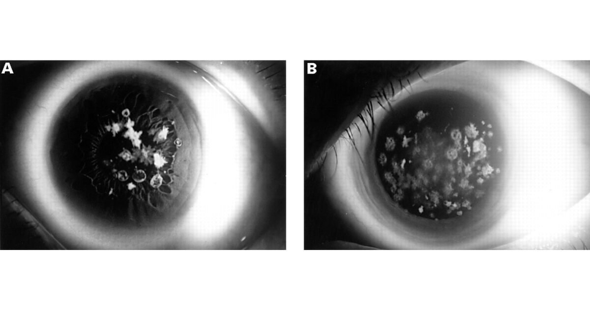 Khi soi đèn khê vào giác mạc thoái hóa dạng Guttata, bác sĩ sẽ thấy hình ảnh giống “kim loại bị rỗ”