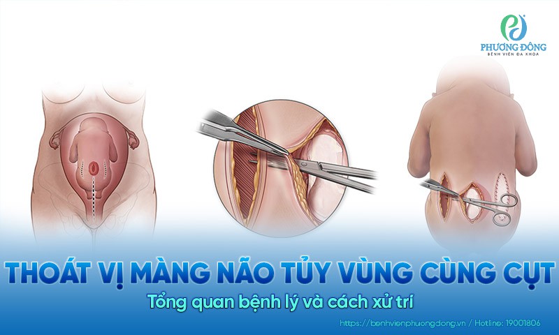 Thoát vị màng não tủy vùng cùng cụt: Tổng quan bệnh lý và cách xử trí